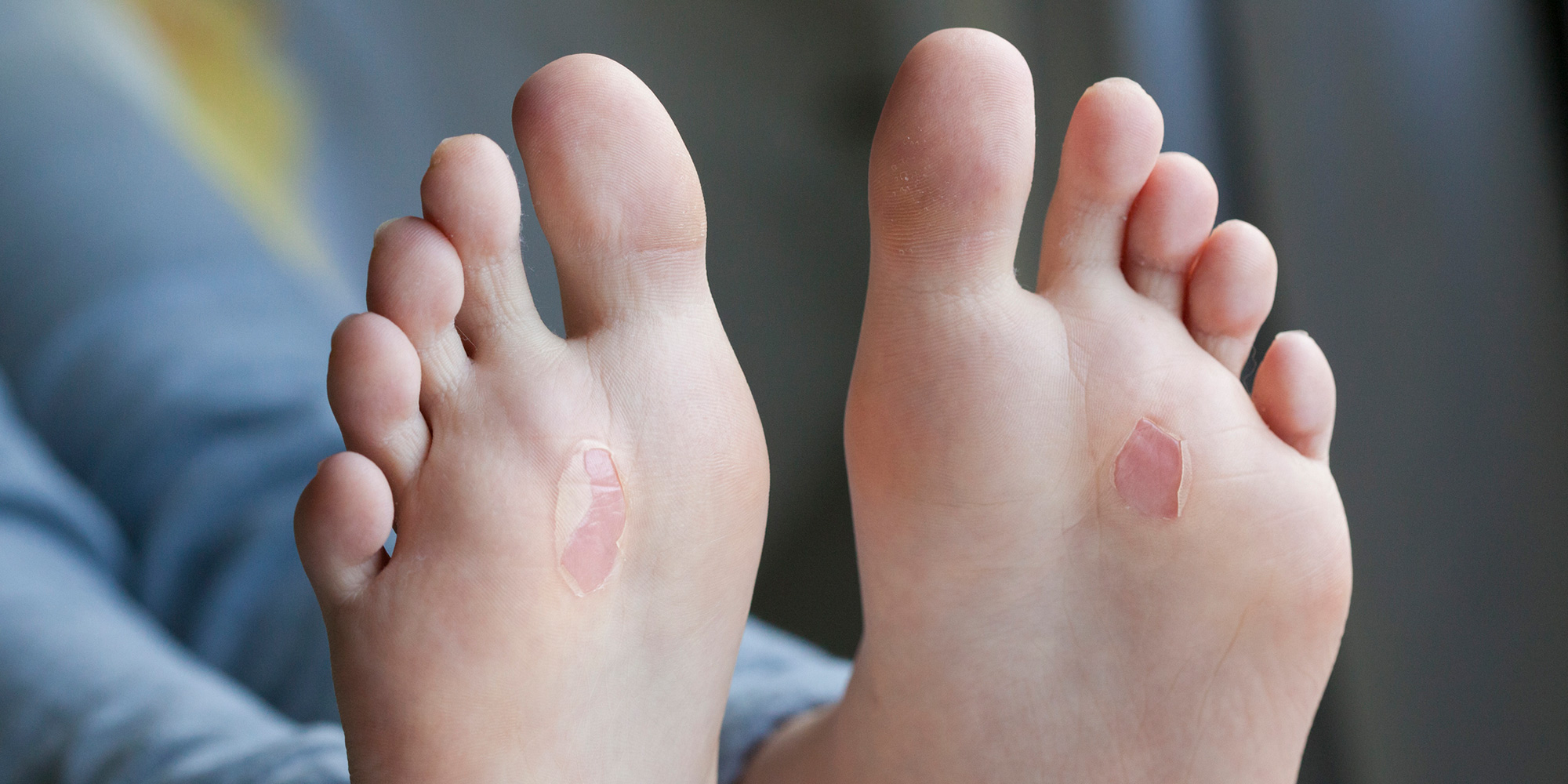 Blisters treatment -Benenati Foot Care Centres