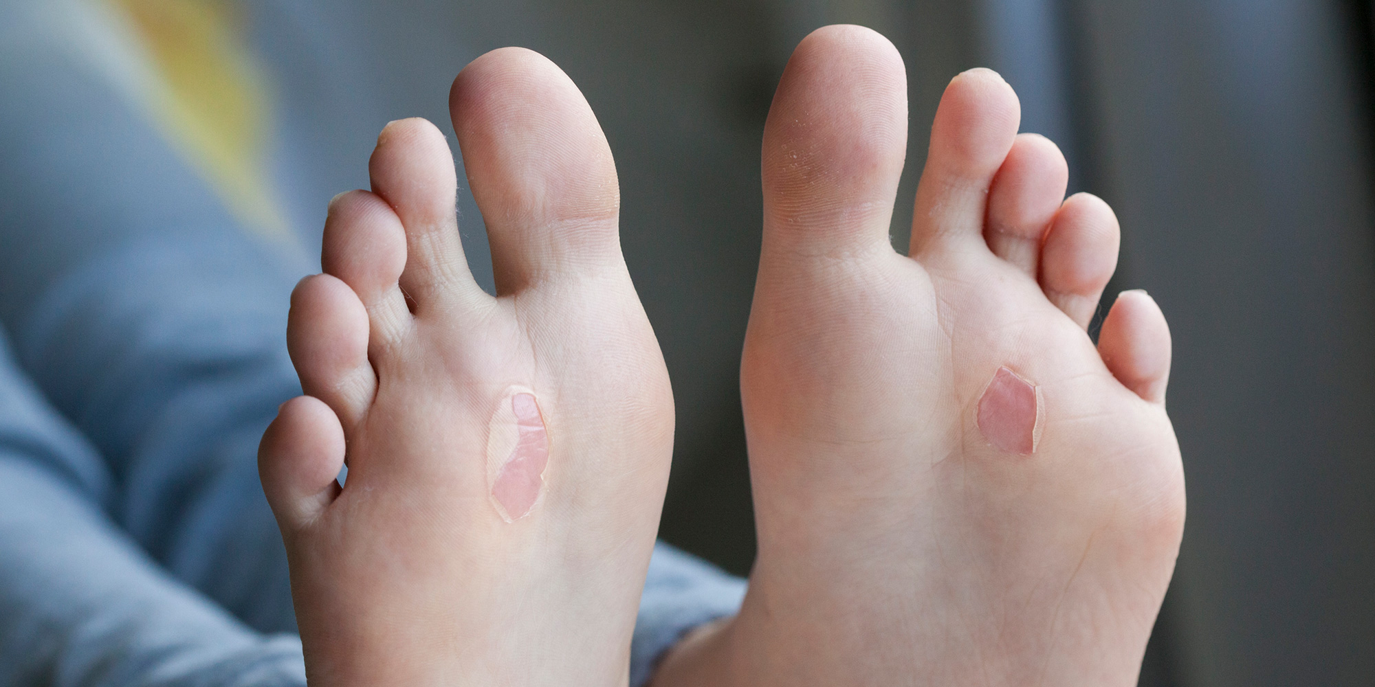 a-55-year-old-man-with-a-painful-rash-on-the-sole-of-his-foot