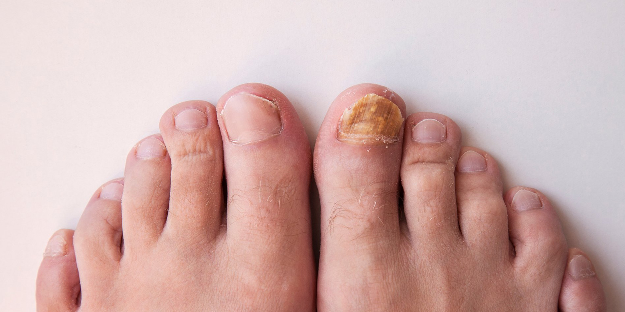 Fungus Problems-Benenati Foot Care Centres