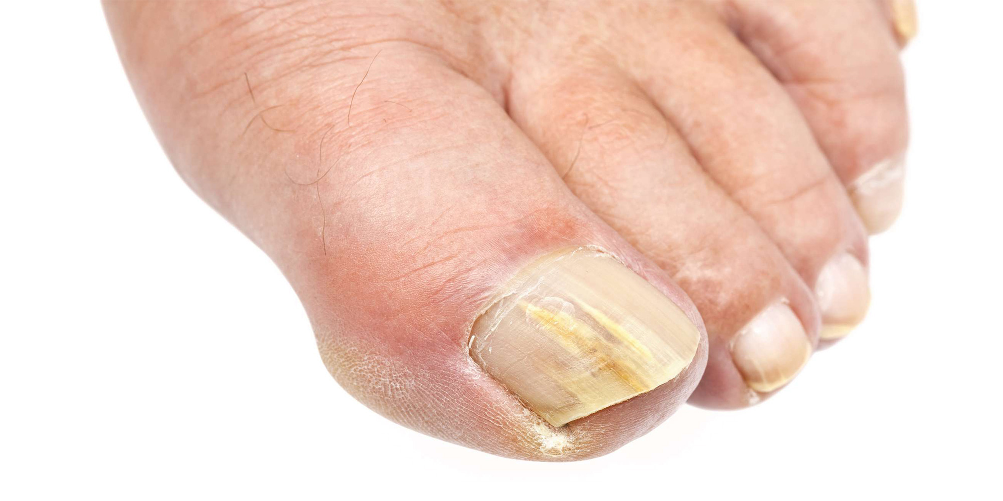 Tonenail Fungus - Advanced foot and ankle specialists