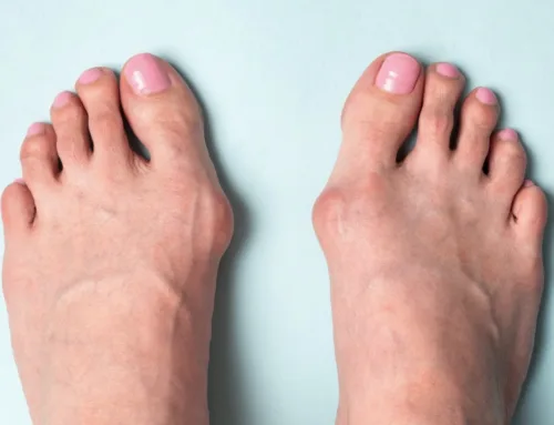 Bunion Pain Explained: When to Seek Expert Help
