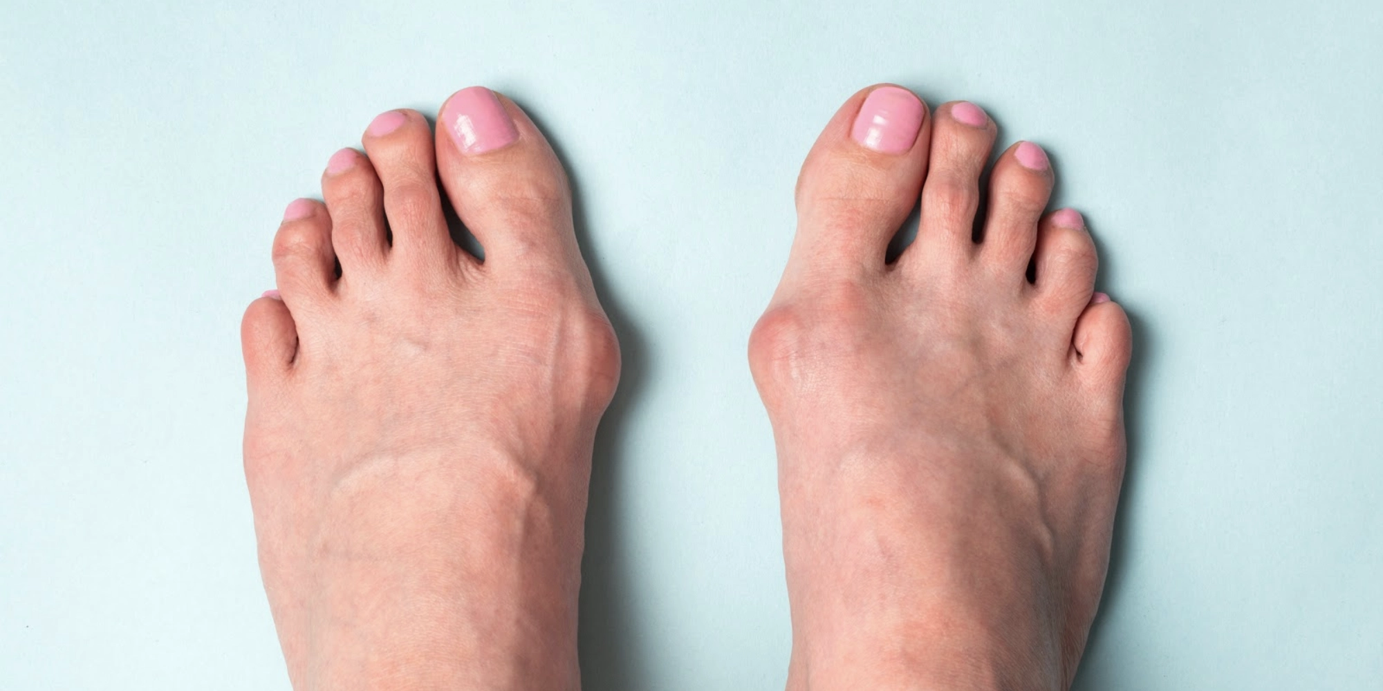 Close-up of foot with visible bunion, side view