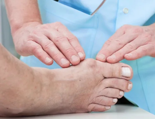 Foot Deformities: Not Just Cosmetic, But Functional Concerns